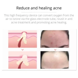 Facial Therapy Wand Facial Therapy Wand